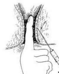 成人可以直肠注射吗视频