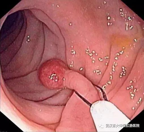 成人可以直肠注射吗视频
